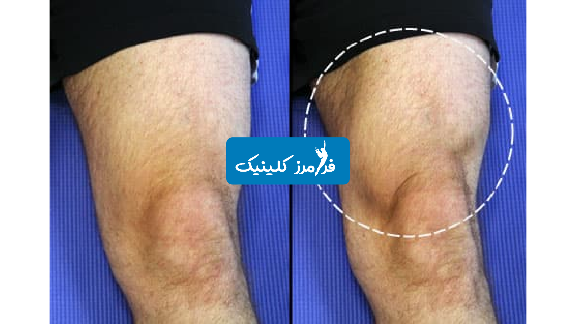 تمرینات آرتروز زانو