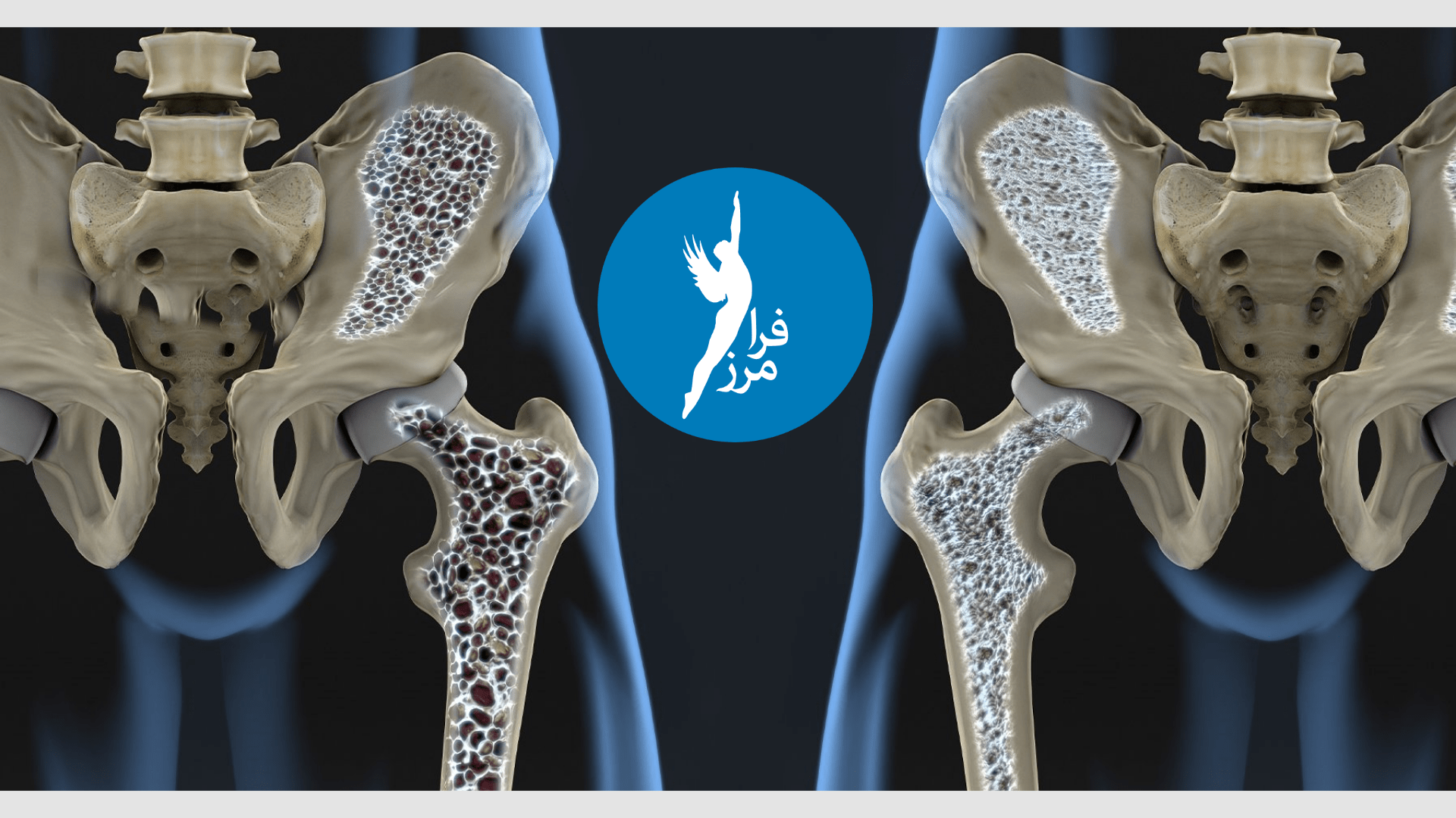 پوکی استخوان چگونه ایجاد می شود؟