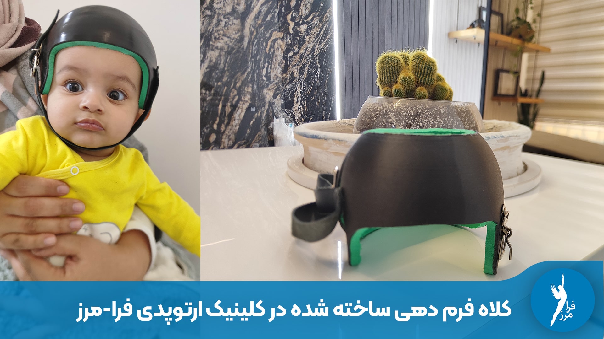 ساخت کلاه فرم دهی سر نوزاد 