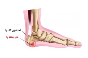 خار پاشنه
