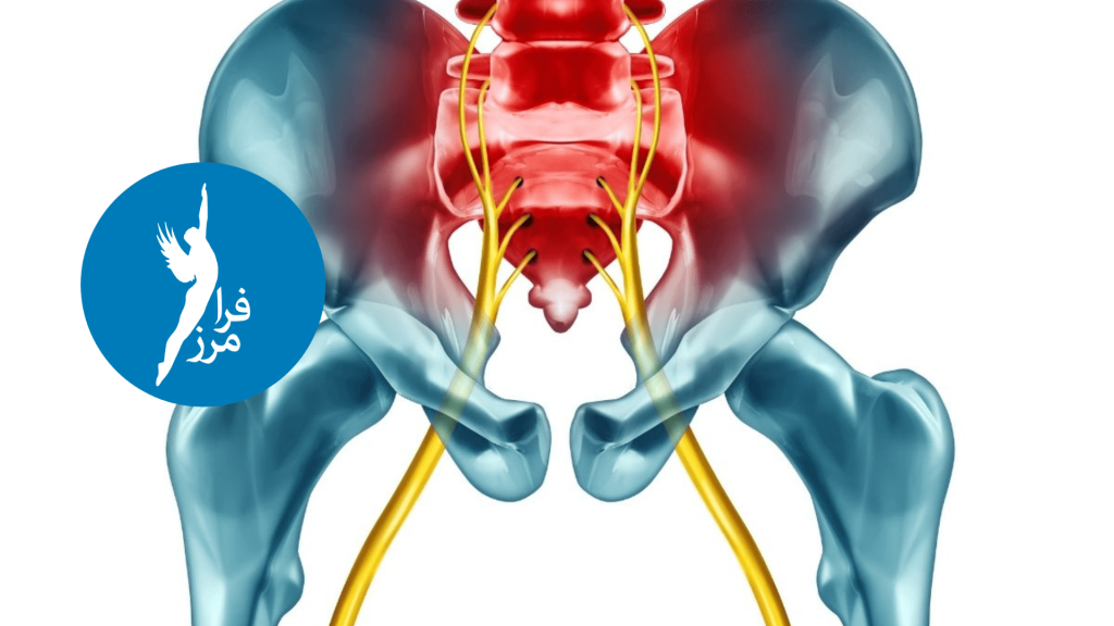 What is sciatica?