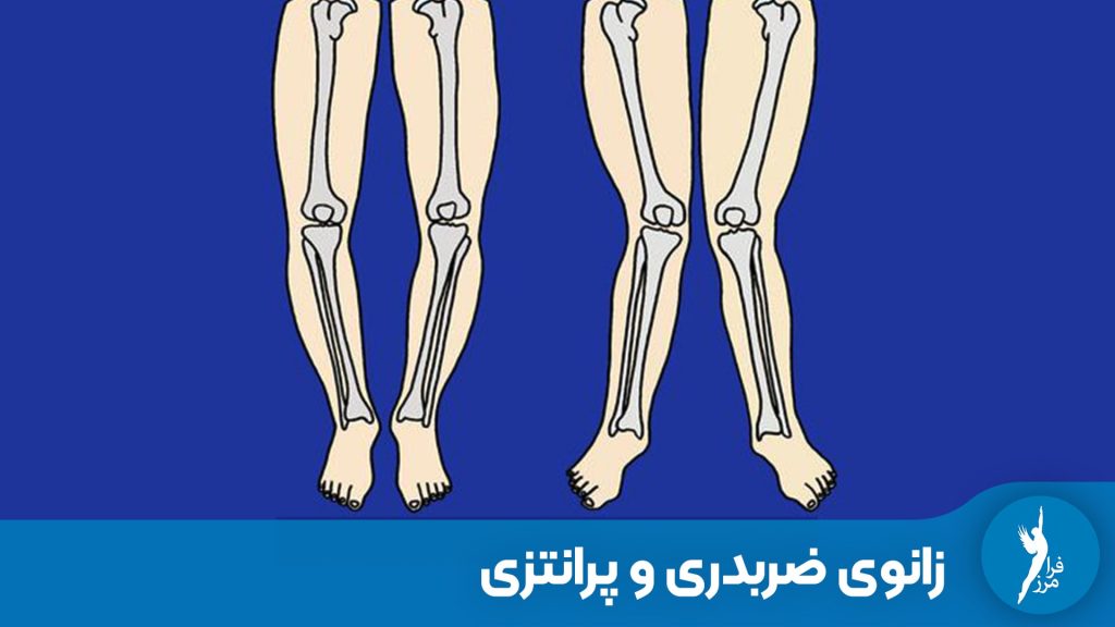 برسی جامع تفاوت های زانوی پرانتزی و ضربدری