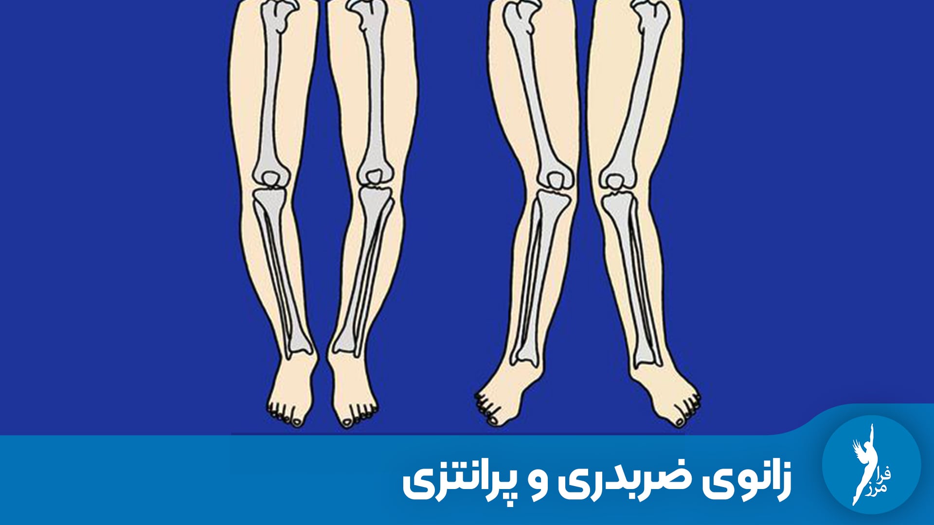برسی جامع تفاوت های زانوی پرانتزی و ضربدری
