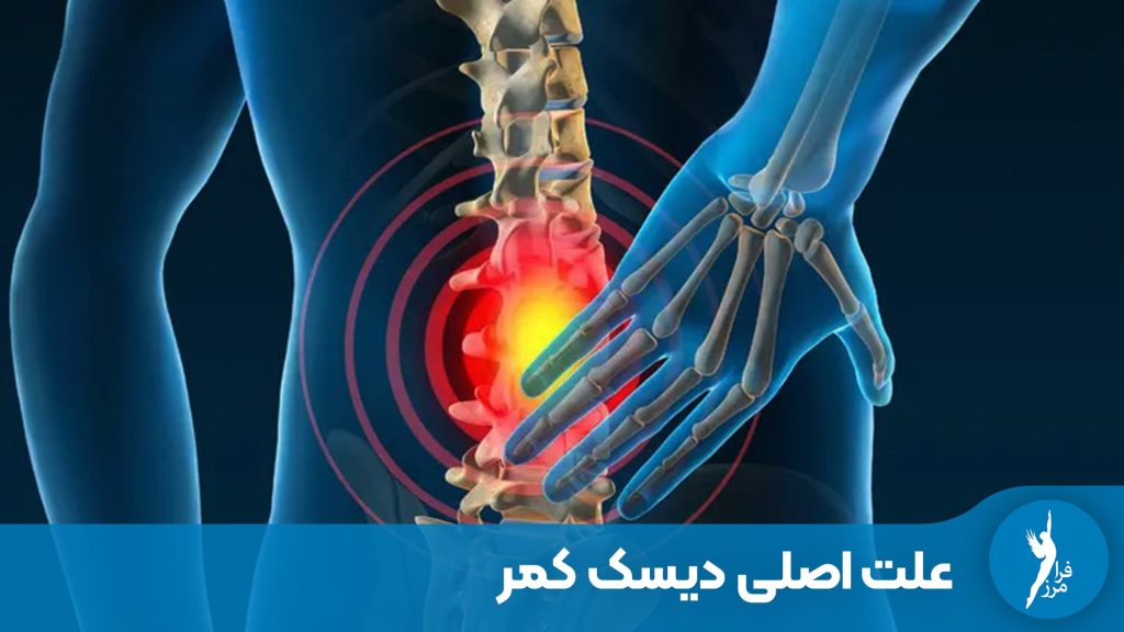 علت اصلی دیسک کمر