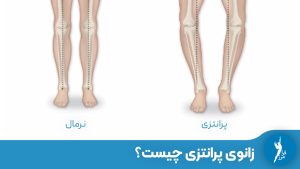 در این مقاله، علت‌ها، علائم، عوارض و روش‌های درمان این ناهنجاری اسکلتی به‌ویژه با زانوبند طبی اختصاصی در کلینیک ارتوپدی فنی فرامرز بررسی شده است.