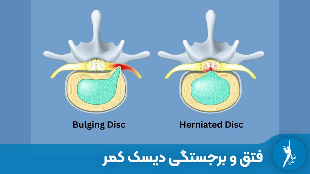 فتق دیسک کمر و برجستگی دیسک کمر