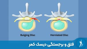 فتق دیسک کمر و برجستگی دیسک کمر