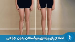 آیا پای پرانتزی در بزرگسالی درمان می‌شود؟ بررسی روش‌های غیر جراحی شامل کفی طبی و زانوبند آنلودر برای کاهش درد زانو و اصلاح انحراف پا.