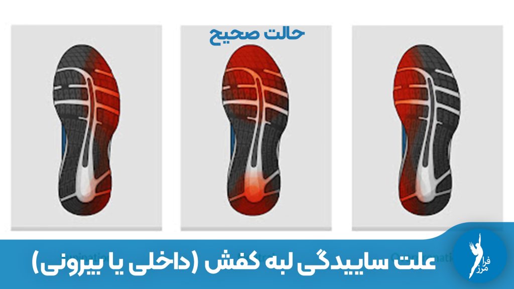 آیا کفش‌هایتان کج ساییده می‌شود؟ ساییدگی لبه داخلی یا بیرونی کفش نشانه چیست؟ راهنمای کامل تشخیص پرونیشن و سوپینیشن از روی کفش و درمان آن با کفی طبی.