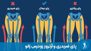 پای ضربدری چگونه باعث تخریب غضروف و آرتروز زودرس زانو می‌شود؟ تحلیل بیومکانیک زانو و معرفی روش‌های درمان غیرجراحی (کفی و بریس آنلودر) برای جلوگیری از ساییدگی.
