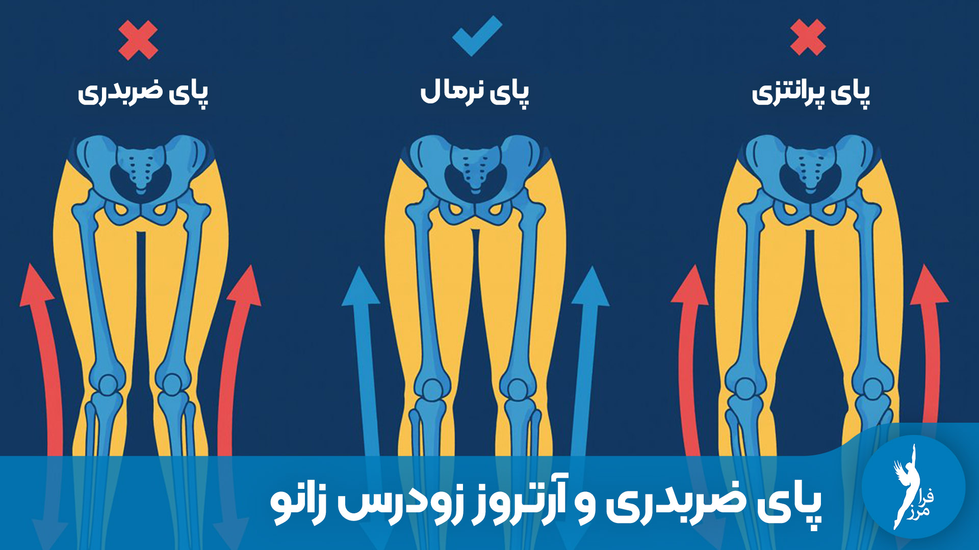 پای ضربدری چگونه باعث تخریب غضروف و آرتروز زودرس زانو میشود؟ تحلیل بیومکانیک زانو و معرفی روشهای درمان غیرجراحی (کفی و بریس آنلودر) برای جلوگیری از ساییدگی.